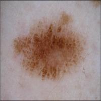 Melanoma Detection